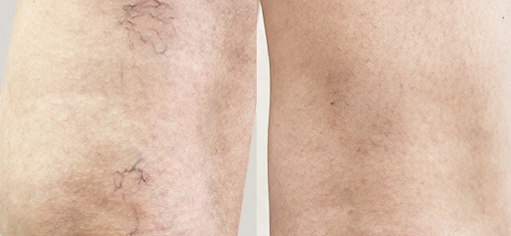 Что такое склеротерапия при варикозе и как она работает?